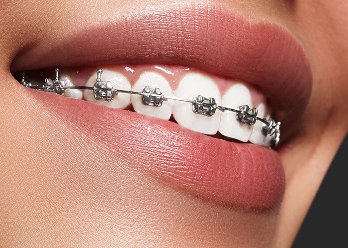 Close-up of a smile with metal fixed braces